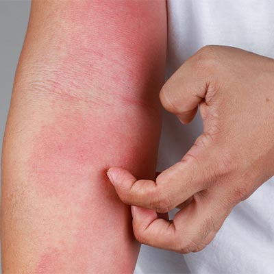 Démangeaisons nocturnes