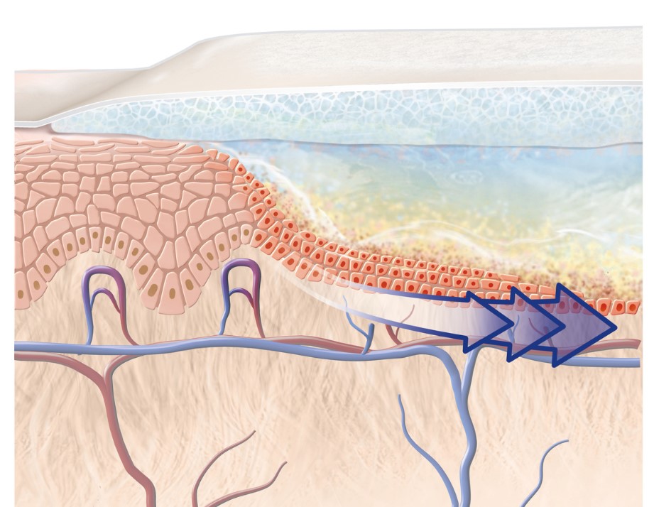 Schéma processus de cicatrisation peau avec pansement