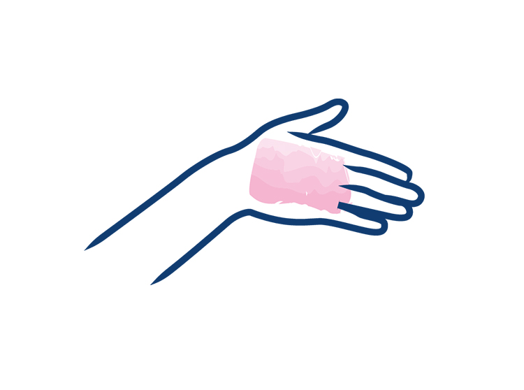 Eczéma chronique des mains