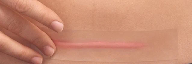 Photo d'une cicatrice césarienne